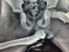 Suka letak kaki atas papan pemuka? Gambar X-ray ini mungkin mengubah tabiat anda