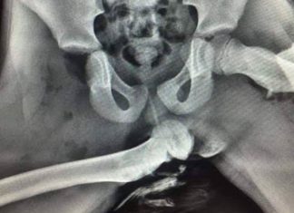 Suka letak kaki atas papan pemuka? Gambar X-ray ini mungkin mengubah tabiat anda