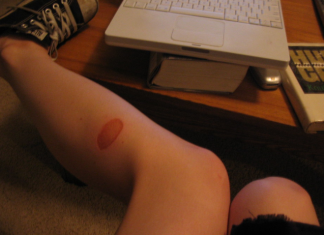 8 bahan semulajadi yang dapat menghilangkan luka dan parut dari ekzos luka parut