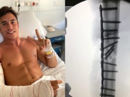 Marc Marquez dedahkan gambar X-ray lengannya ‘sebelum dan selepas’