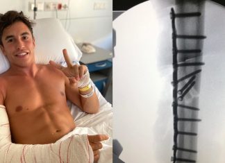 Marc Marquez dedahkan gambar X-ray lengannya ‘sebelum dan selepas’