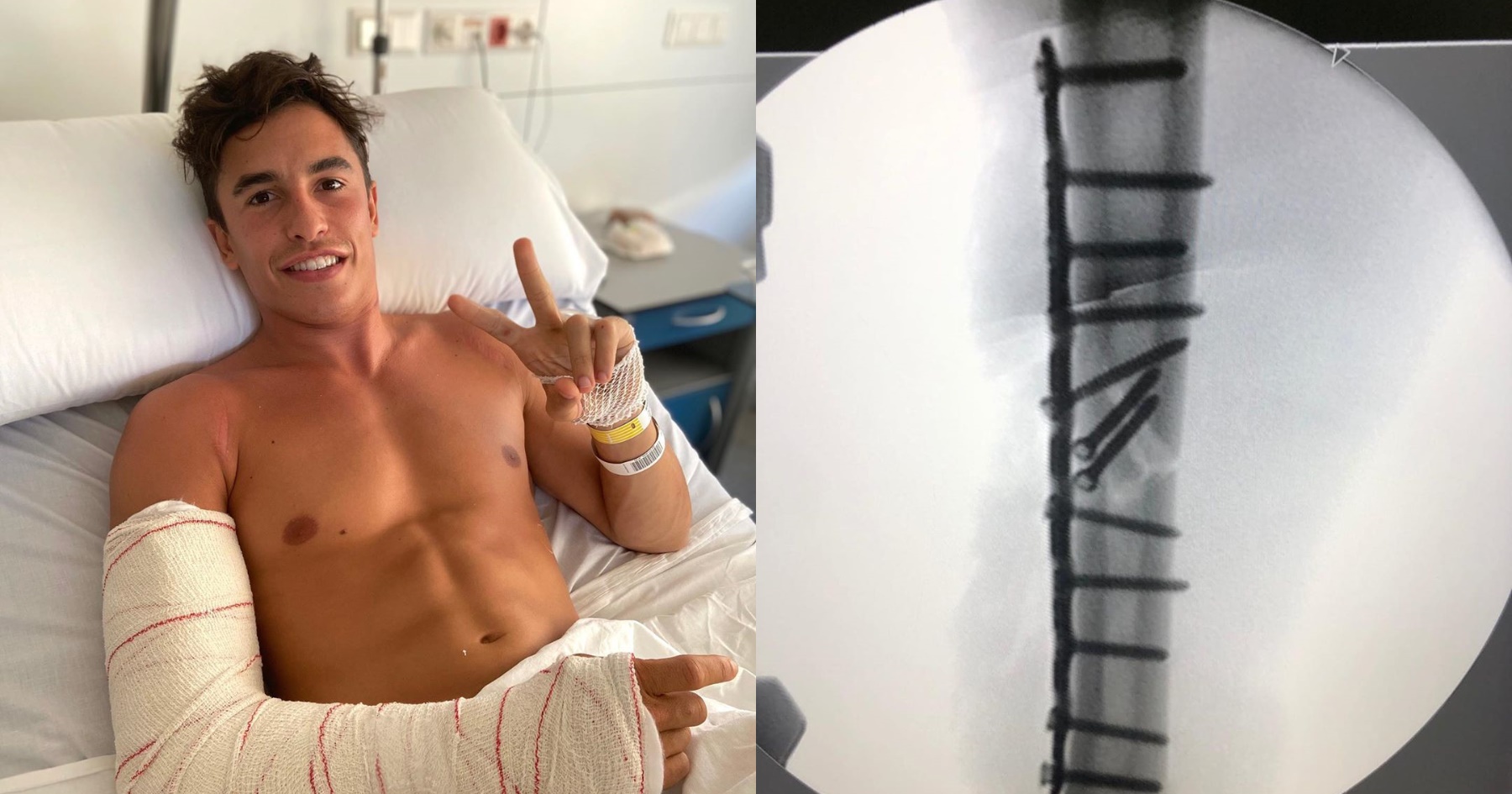 Marc Marquez dedahkan gambar X-ray lengannya 'sebelum dan ...