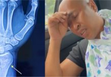 Achey patah tangan kiri ketika cari durian