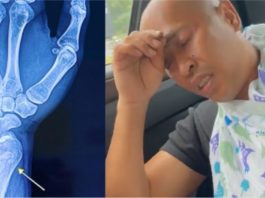 Achey patah tangan kiri ketika cari durian