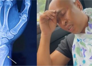 Achey patah tangan kiri ketika cari durian